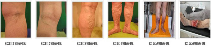 什么是静脉曲张呢?,点击咨询专家