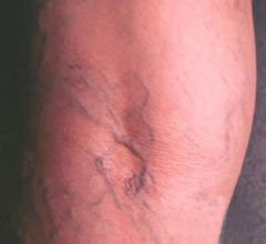 静脉曲张五期症状,有图有真相,点击咨询专家