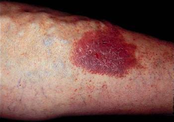 静脉曲张五期症状,有图有真相,点击咨询专家